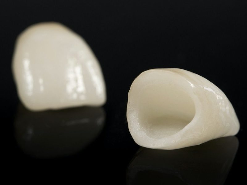 Dental Crowns