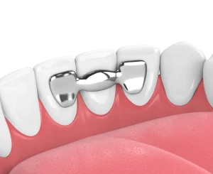 Pros and Cons of Dental Bridges