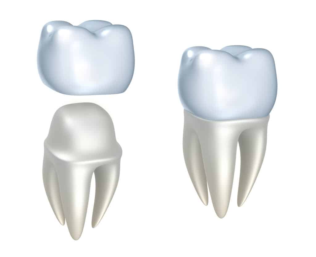 Are dental crowns right for you?