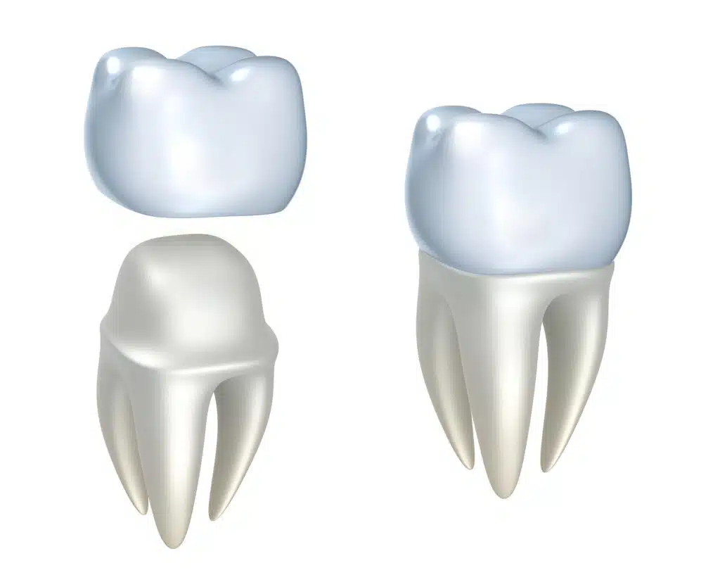 Are dental crowns right for you?