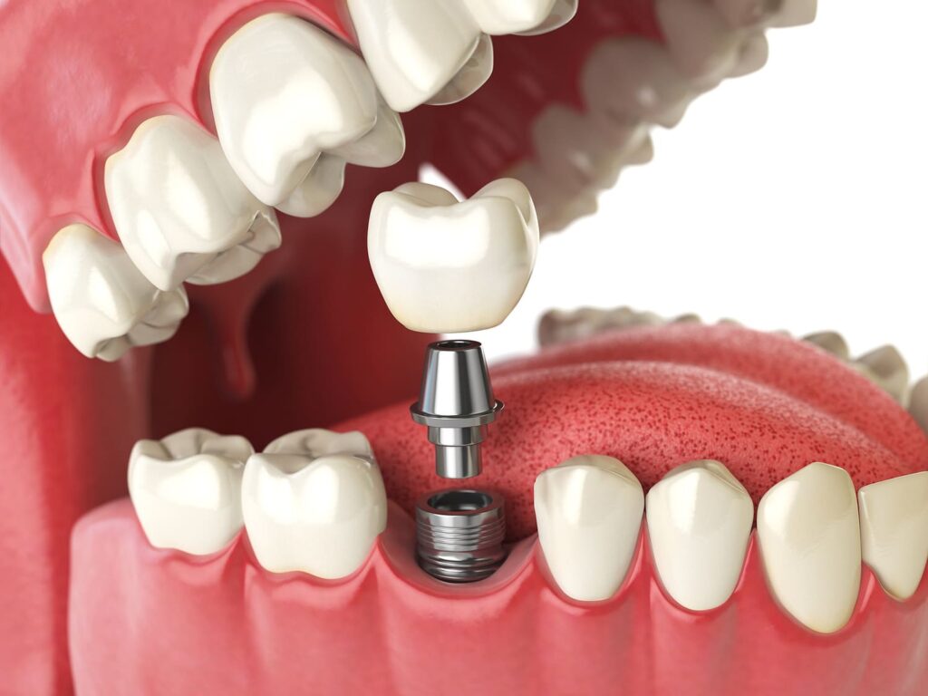 Dental implant cost