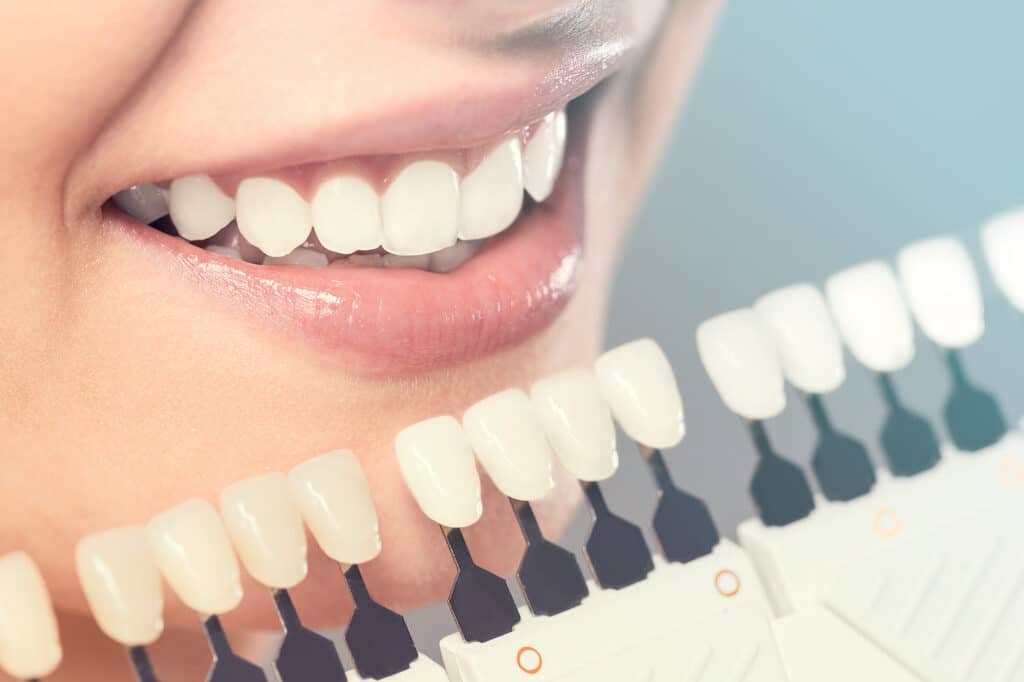 What Are Your Teeth Whitening Options