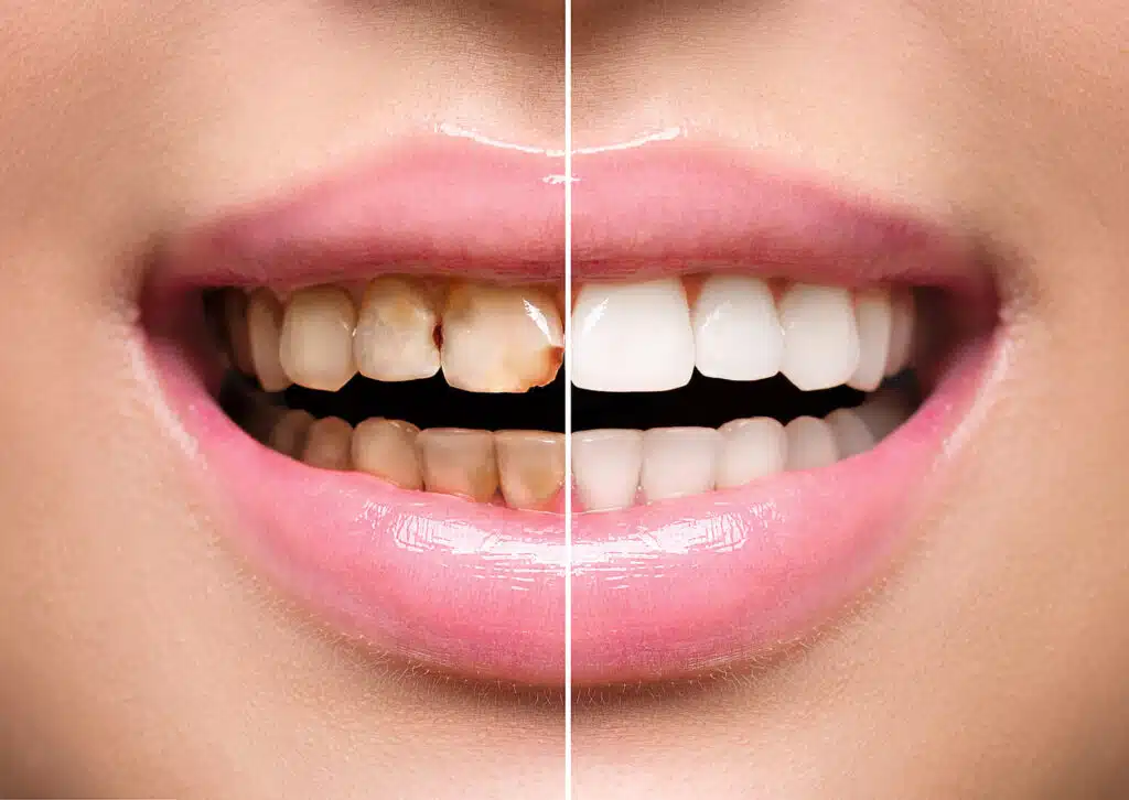 Why Professional Teeth Whitening Works