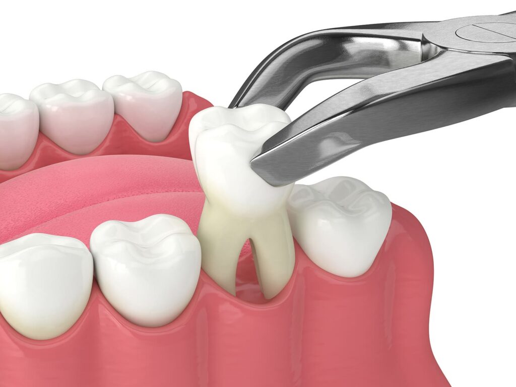 Tooth extraction in Cortland Manor, NY