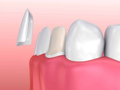 Dental Veneer Illustration Illustration of a porcelain veneer being applied to a tooth.