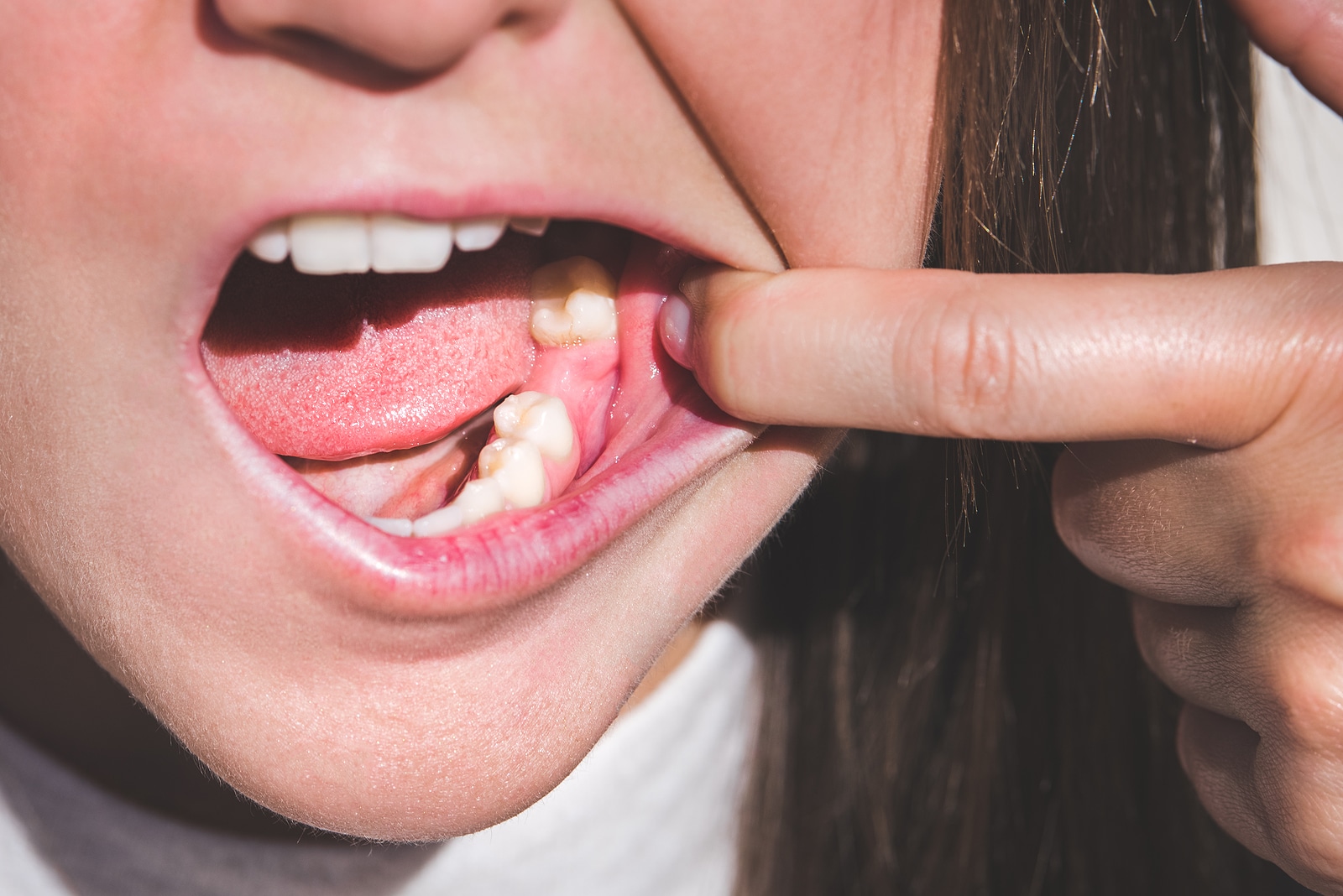 Close-up of a patient showing an empty space where a missing tooth was