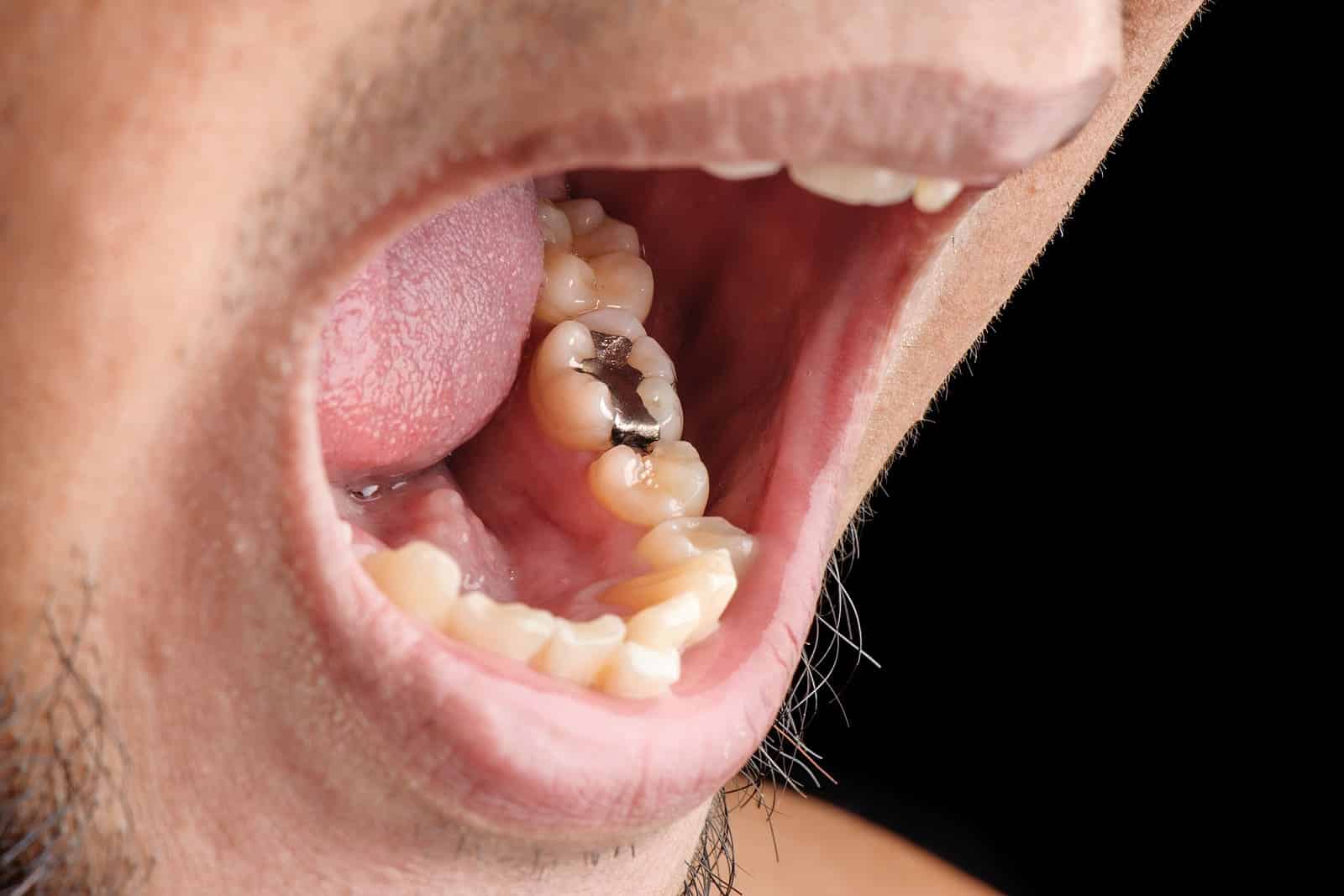 Comfortable dental filling appointment at Hudson Valley Dental Medicine Cortlandt Manor NY