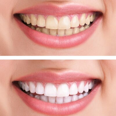 Close-up of a patient receiving a professional teeth whitening treatment