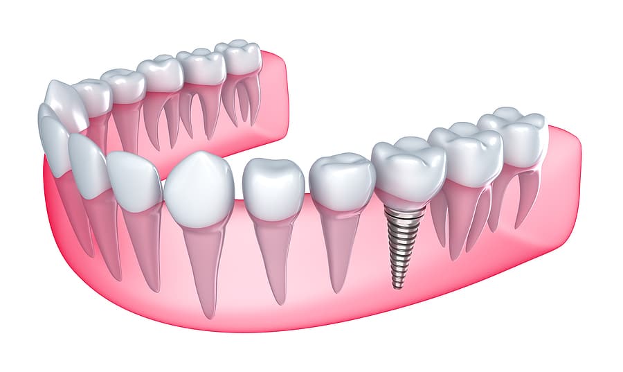 Medical illustration of a single dental implant fixture within a human lower jaw