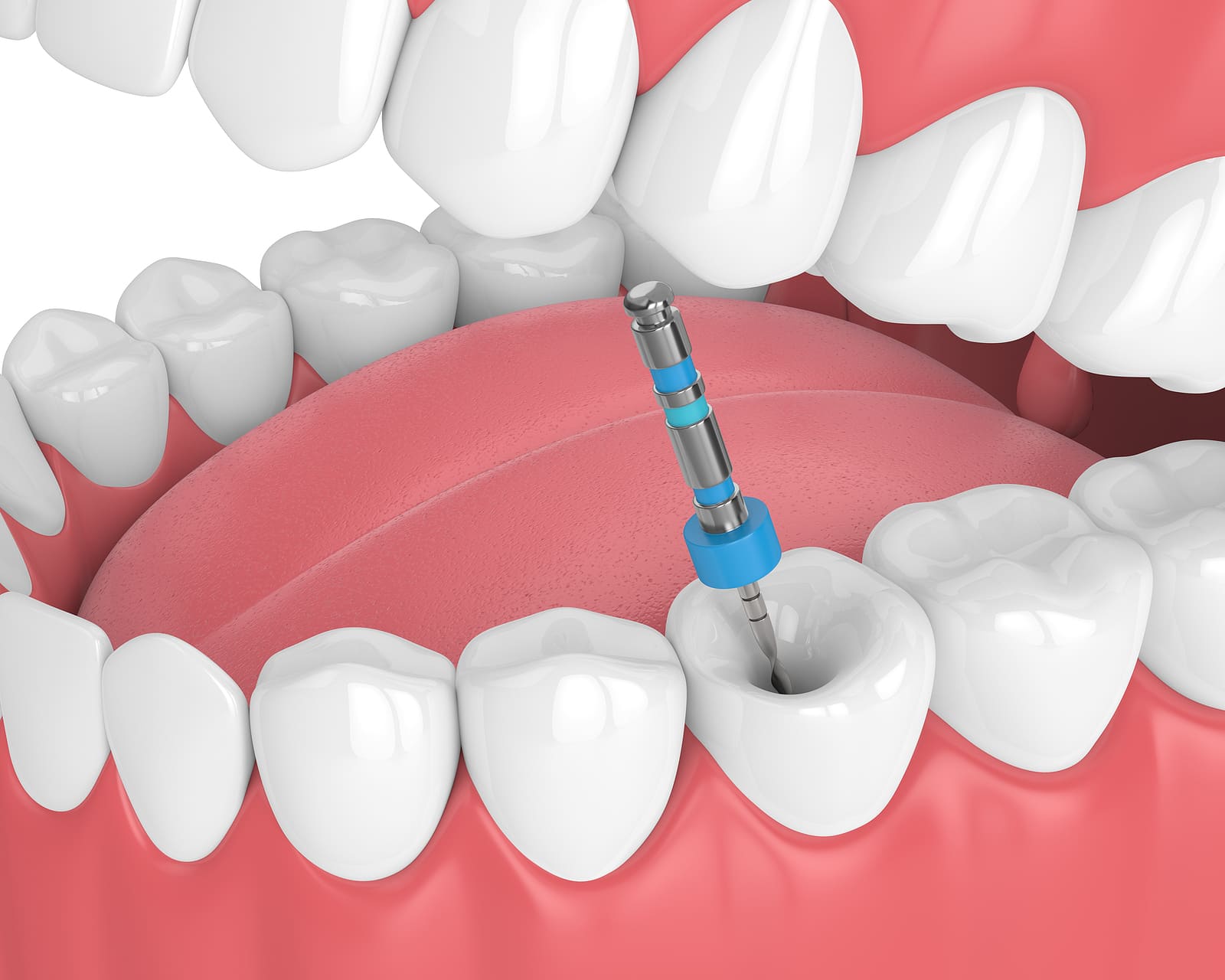 Comfortable root canal appointment at Hudson Valley Dental Medicine Cortlandt Manor NY