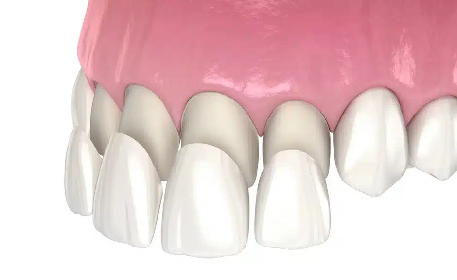 Benefits of Porcelain Veneers